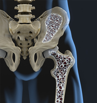 Osteoporotic Bones